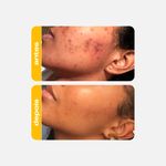 acido-latico-creamy-amarelinho-acne-5