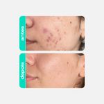 glicointense-peel-glicolico-salicilico-niacinamida-antiacne-acido-verdinho-creamy-5