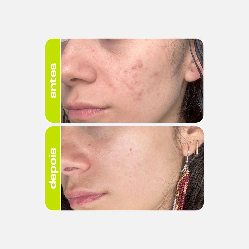 tonico-de-acido-tranexamico-creamy-clareador-melasma-5